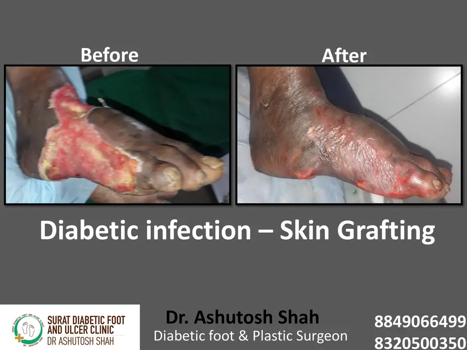 Diabetic Foot  PPT 3 checked by sir.pptx-90.webp